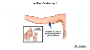 l'implant contraceptif
